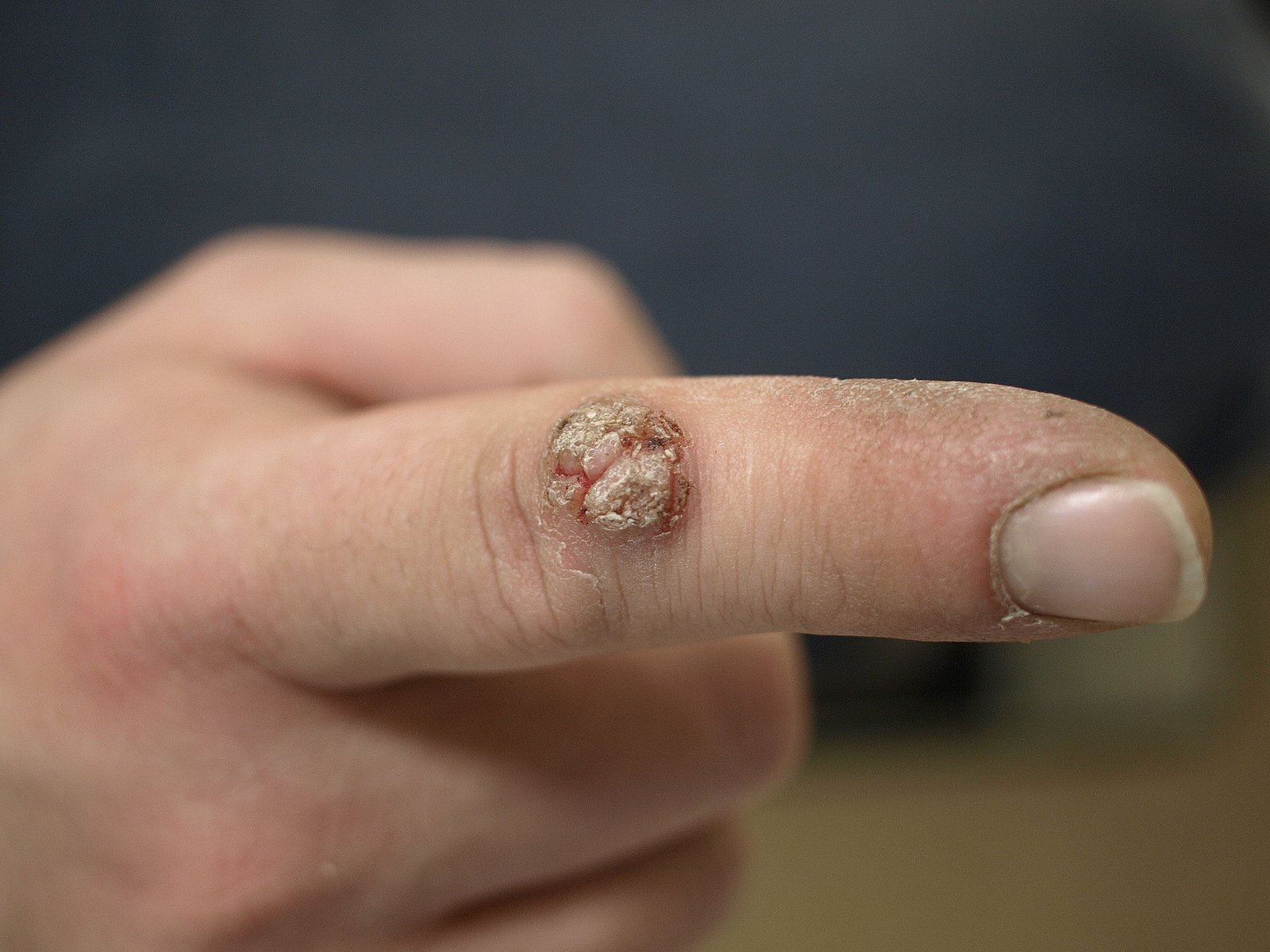 hpv warzen