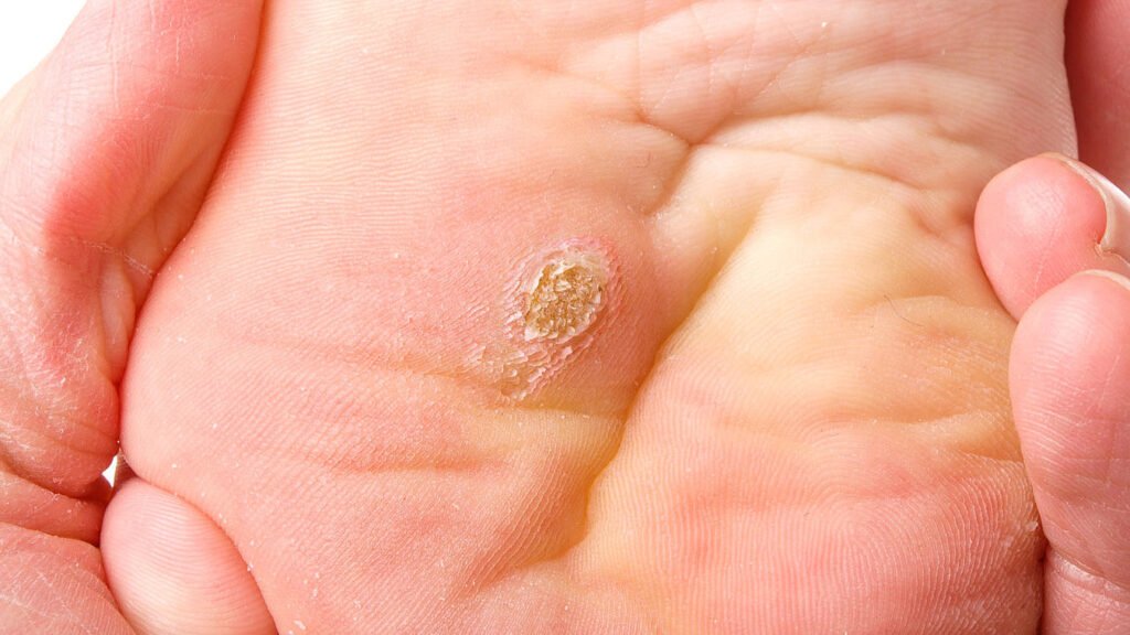 hpv warzen