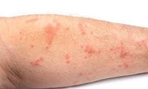 milben allergie